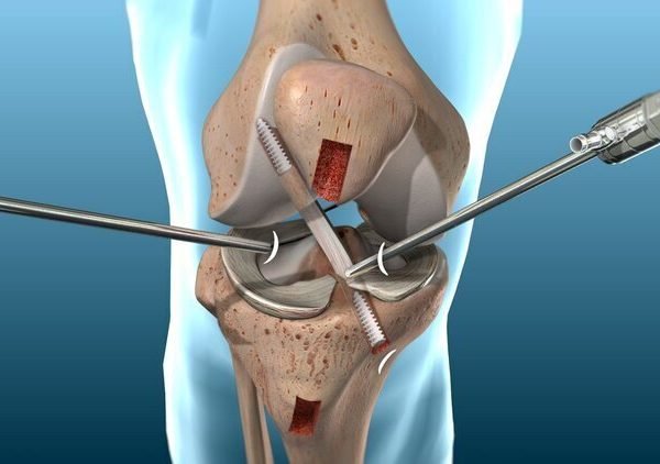 ACL+Repair