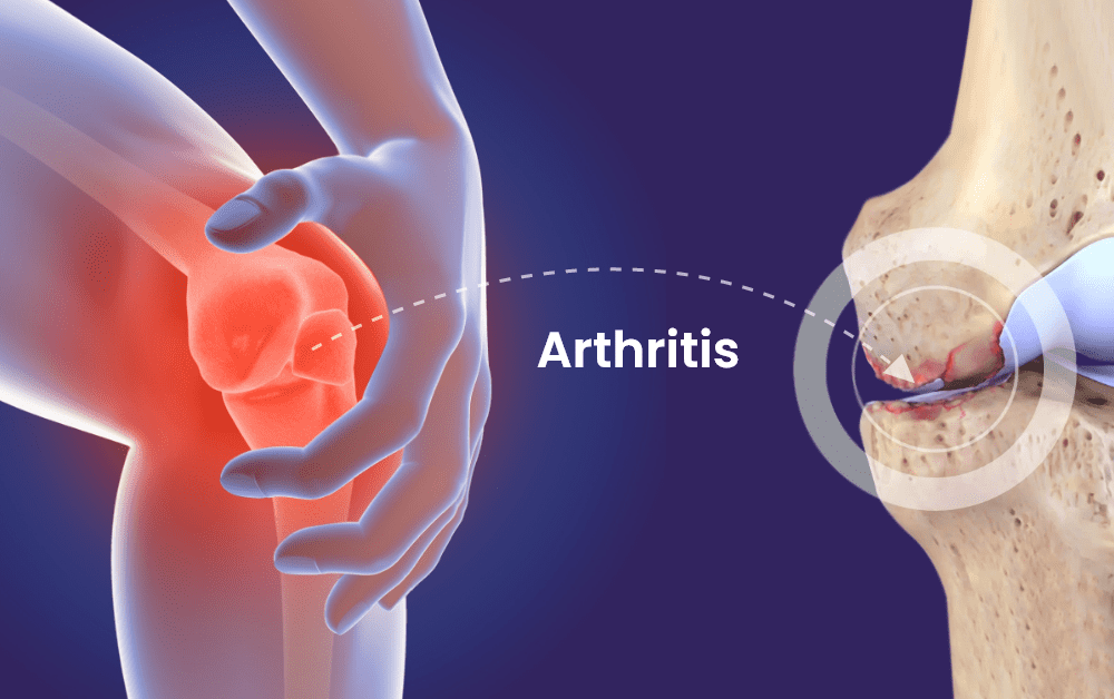 Arthritis0